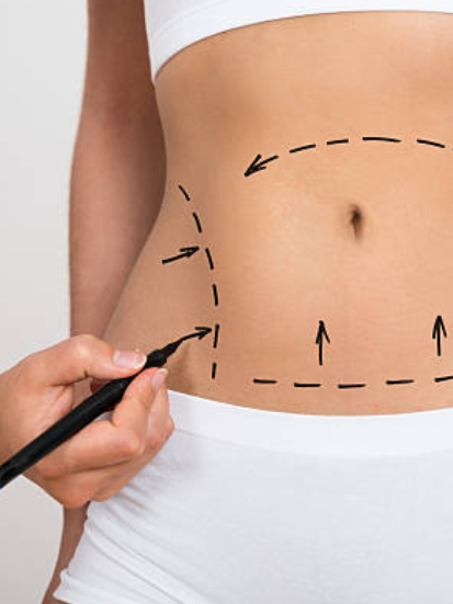 Liposuction